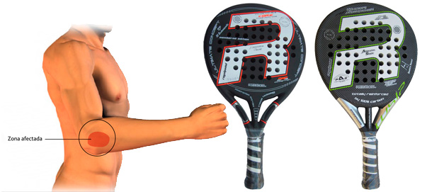 Las mejores palas para evitar lesiones brazo - Zona de Padel